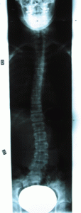 rx scoliose