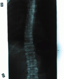 rx scoliose