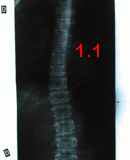 rx scoliose 1.1-170303