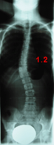 rx scoliose 1.2-180803