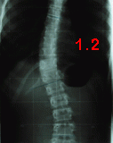 rx scoliose 1.2-180803