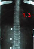 rx scoliose 1.3-240903