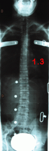 rx scoliose 1.3-240903