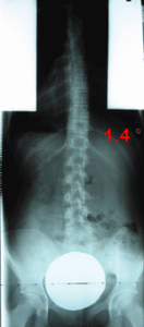 rx scoliose 1.4-2ans