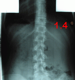 rx scoliose 1.4-2ans