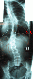 rx scoliose 2.3-020601