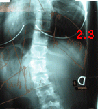 rx scoliose 2.3-020601
