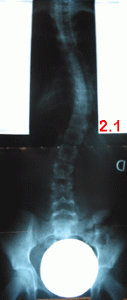 rx scoliose 2.1-040800