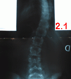 rx scoliose 2.1-040800