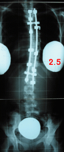 rx scoliose 2.5-140502