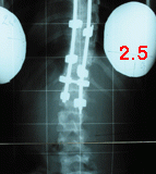 rx scoliose 2.5-140502