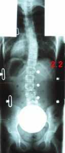 rx scoliose 2.2-140800