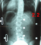 rx scoliose 2.2-140800