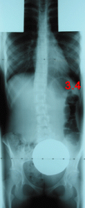 rx scoliose 3.4-15mois