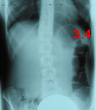 rx scoliose 3.4-15mois