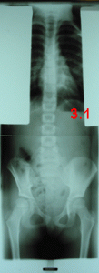 rx scoliose 3.1-171294