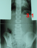 rx scoliose 3.1-171294