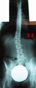 rx scoliose 3.2-190602