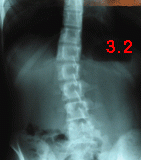 rx scoliose 3.2-190602