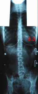 rx scoliose 3.3-291002