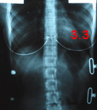 rx scoliose 3.3-291002