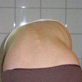 scoliose test debout flexion